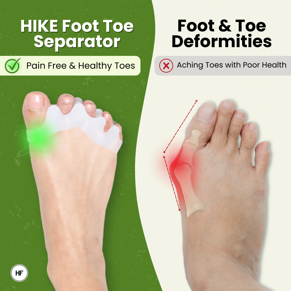 HIKE Foot Toe Separator - Gezonde tenen, correctie van bunions, hamertenen en verlichting van voetpijn